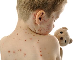 Caso importado de sarampo acende alerta para a vacinação contra a doença