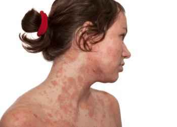 No mês mundial de conscientização da Dermatite Atópica, especialista chama atenção para os cuidados nas estações mais quentes