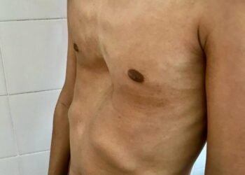 Deformidade da parede torácica pode gerar complexo de inferioridade e dificuldade nas relações sociais