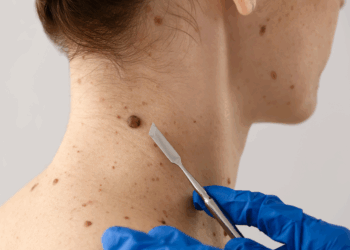 Dezembro Laranja: dermatologista alerta para os riscos do câncer de pele durante o Verão