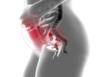 A endometriose pode afetar o intestino?