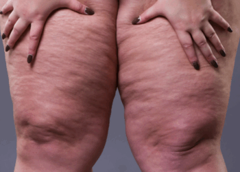 Médicos alertam para risco de distúrbio na menopausa causado pela lipedema