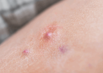 Junho Roxo: campanha chama atenção para a Hidradenite Supurativa