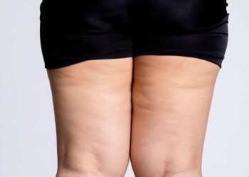 Lipedema: o que é e como tratar a doença que leva ao acúmulo de gordura em partes do corpo