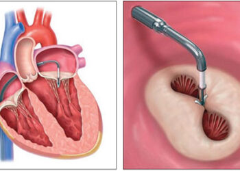 Mitraclip surge como alternativa segura e eficaz para pessoas idosas com insuficiência mitral