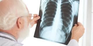 Dia Mundial da Tuberculose: veja 5 sinais de alerta da doença