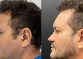 Ximbinha passa por transformação e faz lipoescultura facial