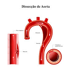 Campanha alerta para conscientização sobre a dissecção da aorta