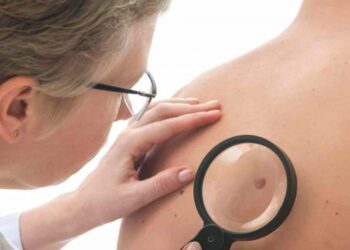 Pacientes com diagnóstico de câncer de pele participarão na Bahia de estudo mundial para vacina contra o doença