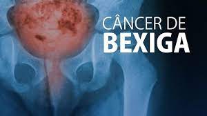 Câncer de bexiga ultrapassa 19 mil mortes em 4 anos