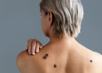 Câncer de pele atinge 16% mais mulheres
