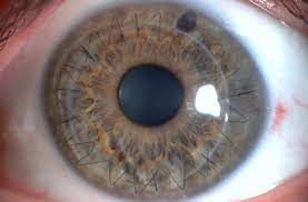 Fila para transplantes de córnea no país quase triplica em uma década