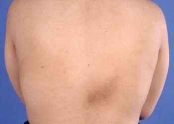 Dor e coceira nas costas podem ser sinais de notalgia parestésica