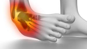 Lesões ortopédicas: quais são as mais comuns?