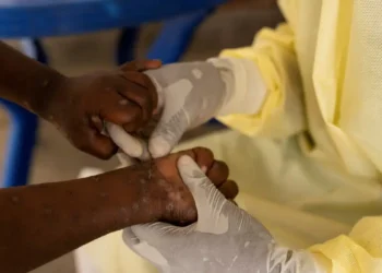 OMS avalia se mpox deve voltar a ser declarada emergência global