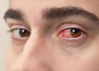 Herpes ocular requer tratamento para evitar sequelas visuais