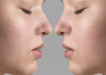 Rinoplastia: estética ou saúde? Entenda quando a cirurgia do nariz é necessária