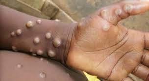 OMS mantém por mais um ano recomendações para combater mpox na África