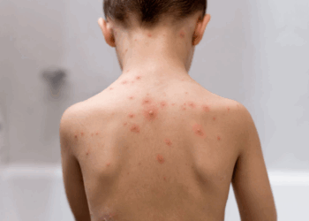 Casos de catapora crescem 10,7% na Bahia em 2025; doença pode ser prevenida com vacina