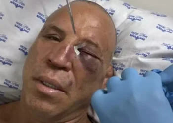 Wanderlei Silva sofre fratura no nariz e leva pontos após briga no Spaten Fight Night