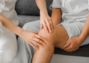 Estou com varizes. E agora?