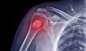 Sarcomas ósseos: do diagnóstico ao tratamento