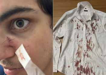 Turista diz que teve hemorragia e levou pontos no nariz após ser agredido durante assalto no Festival Virada Salvador