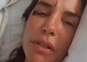 Ivete mostra corte no rosto e conta que desmaiou após infecção intestinal