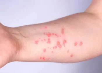 Sesab confirma casos de Mpox em Salvador e Vitória da Conquista e investiga mais casos suspeitos