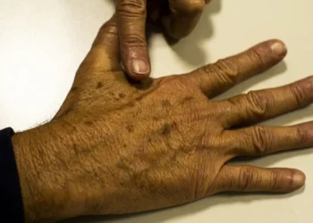 Desinformação sobre câncer de pele afeta diagnóstico, diz instituição