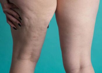 Junho Roxo alerta para sinais do lipedema e importância do diagnóstico precoce
