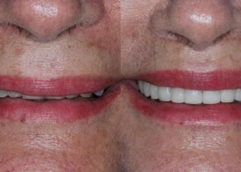Liplift se consolida como opção para rejuvenescimento dos lábios com resultado duradouro